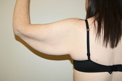 Arm Lift Before & After Patient #3493