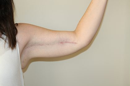 Arm Lift Before & After Patient #3493