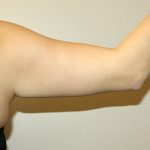 Arm Lift Before & After Patient #3494