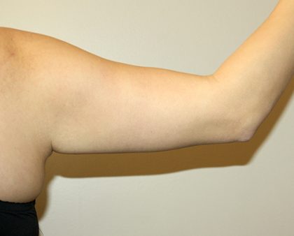 Arm Lift Before & After Patient #3494