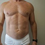 Liposuction Before & After Patient #3703