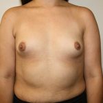 Breast Augmentation Before & After Patient #3626