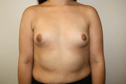 Breast Augmentation Before & After Patient #3626