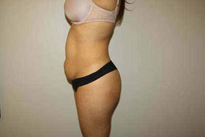 Tummy Tuck Before & After Patient #3793
