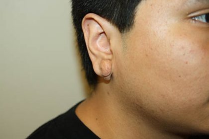 Keloid Surgery Before & After Patient #3687