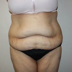 Mommy Makeover Before & After Patient #3738