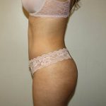 Tummy Tuck Before & After Patient #3793