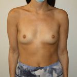 Breast Augmentation Before & After Patient #3627