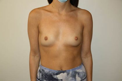 Breast Augmentation Before & After Patient #3627