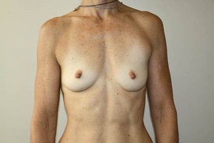 Breast Augmentation Before & After Patient #3628