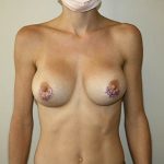 Breast Implant Removal Before & After Patient #3607