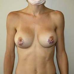Breast Implant Removal Before & After Patient #3607