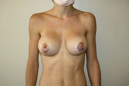 Breast Implant Removal Before & After Patient #3607