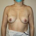 Auto-Augmentation Breast Lift Before & After Patient #4043