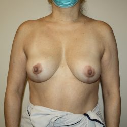 Auto-Augmentation Breast Lift Before & After Patient #4043