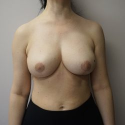 Auto-Augmentation Breast Lift Before & After Patient #4036