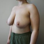 Auto-Augmentation Breast Lift Before & After Patient #4045