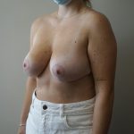 Auto-Augmentation Breast Lift Before & After Patient #4035