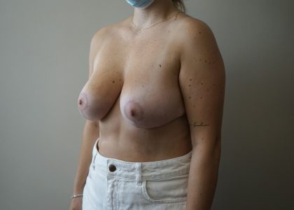 Auto-Augmentation Breast Lift Before & After Patient #4035