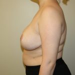 Auto-Augmentation Breast Lift Before & After Patient #4038