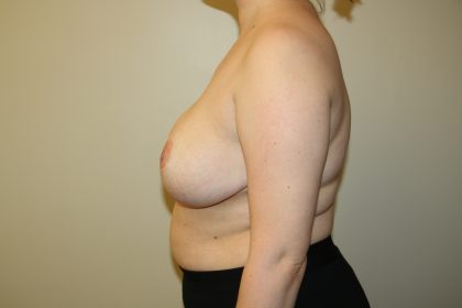 Auto-Augmentation Breast Lift Before & After Patient #4038