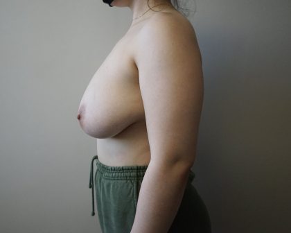 Auto-Augmentation Breast Lift Before & After Patient #4045