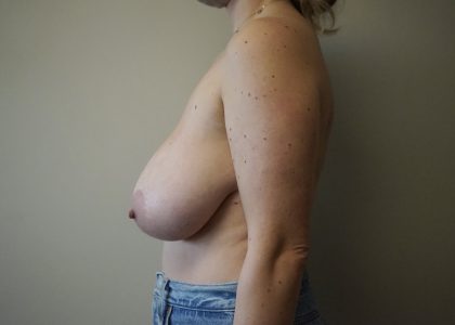 Auto-Augmentation Breast Lift Before & After Patient #4035