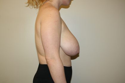 Auto-Augmentation Breast Lift Before & After Patient #4034