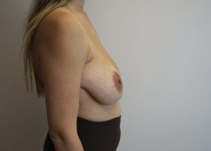 Auto-Augmentation Breast Lift Before & After Patient #4041