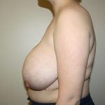 Auto-Augmentation Breast Lift Before & After Patient #4038