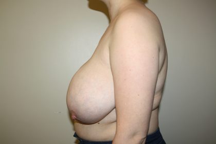 Auto-Augmentation Breast Lift Before & After Patient #4038