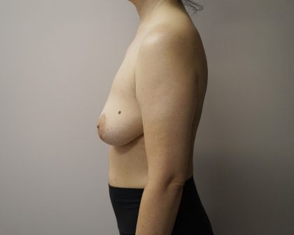 Auto-Augmentation Breast Lift Before & After Patient #4036