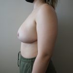 Auto-Augmentation Breast Lift Before & After Patient #4045