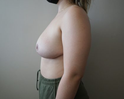 Auto-Augmentation Breast Lift Before & After Patient #4045