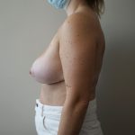 Auto-Augmentation Breast Lift Before & After Patient #4035