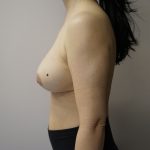 Auto-Augmentation Breast Lift Before & After Patient #4036